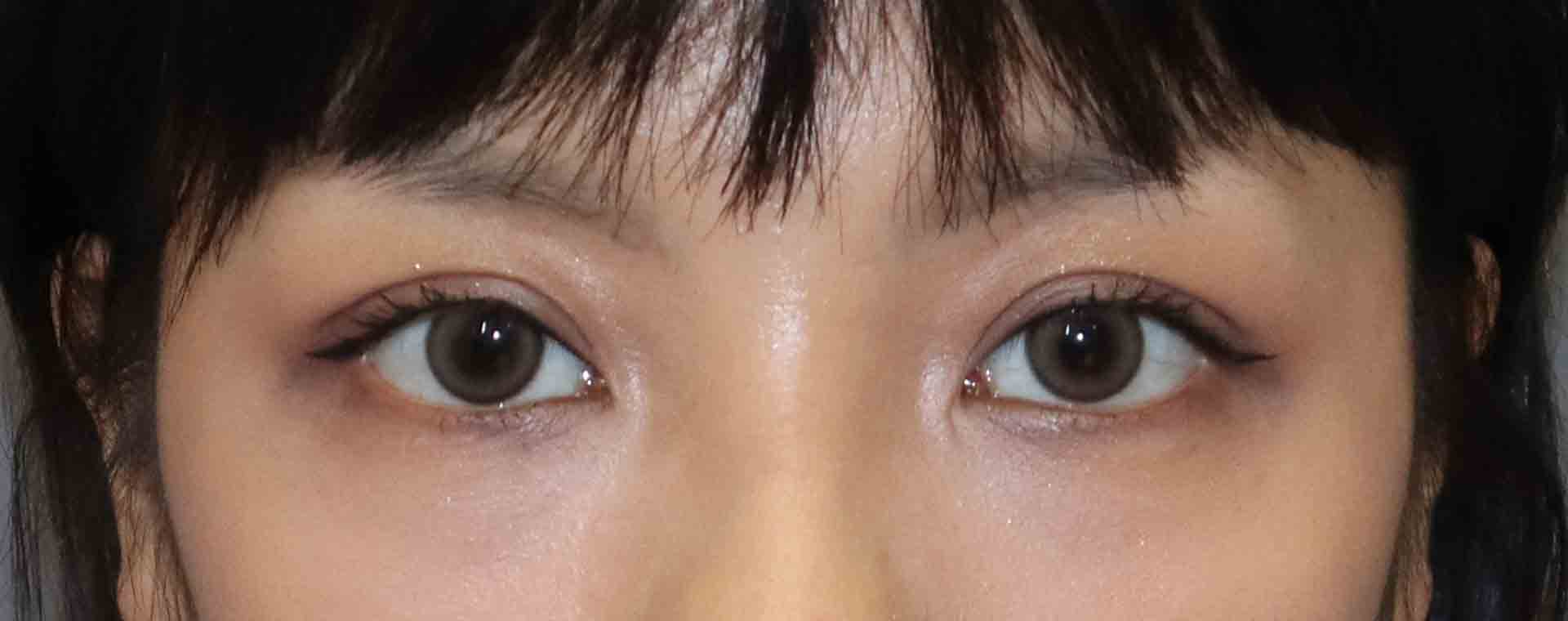 雙眼皮手術推薦醫師-縫雙眼皮後遺症-割雙眼皮恢復期