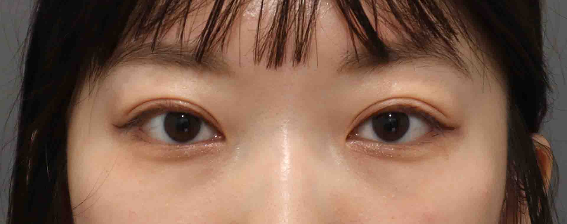 雙眼皮手術-雙眼皮手術推薦醫師-縫雙眼皮後遺症-割雙眼皮恢復期-割雙眼皮價錢-雙眼皮手術恢復-台北割雙眼皮價錢