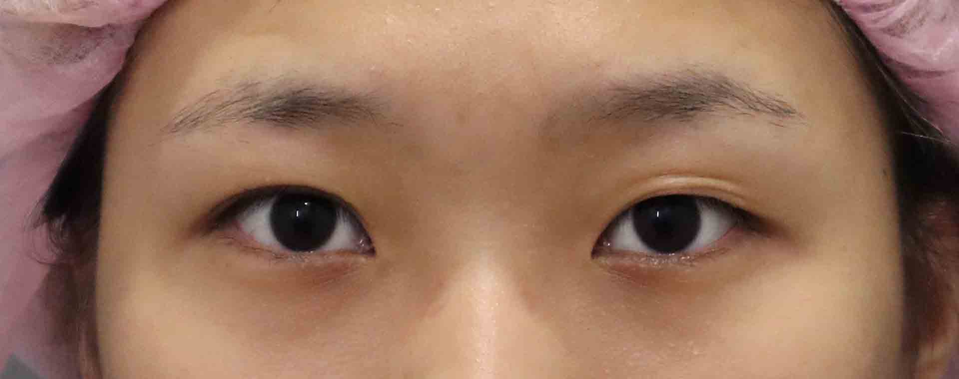 雙眼皮手術-雙眼皮手術推薦醫師-縫雙眼皮後遺症-割雙眼皮恢復期-割雙眼皮價錢