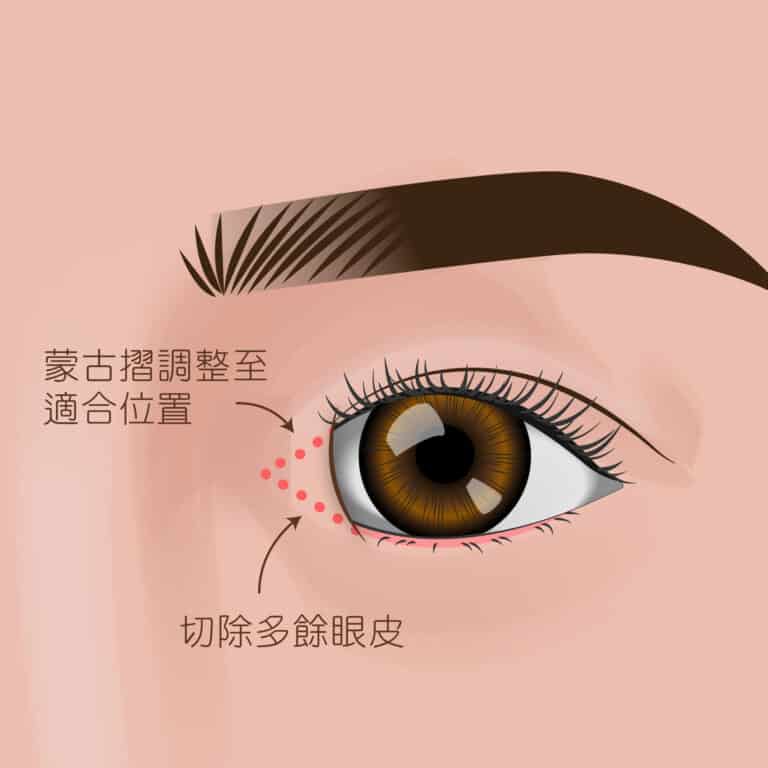 台北開眼頭-開眼頭費用-什麼人適合開眼頭-開眼頭好處-台北開眼頭推薦-開眼頭手術費用-開眼頭價位-開眼頭案例